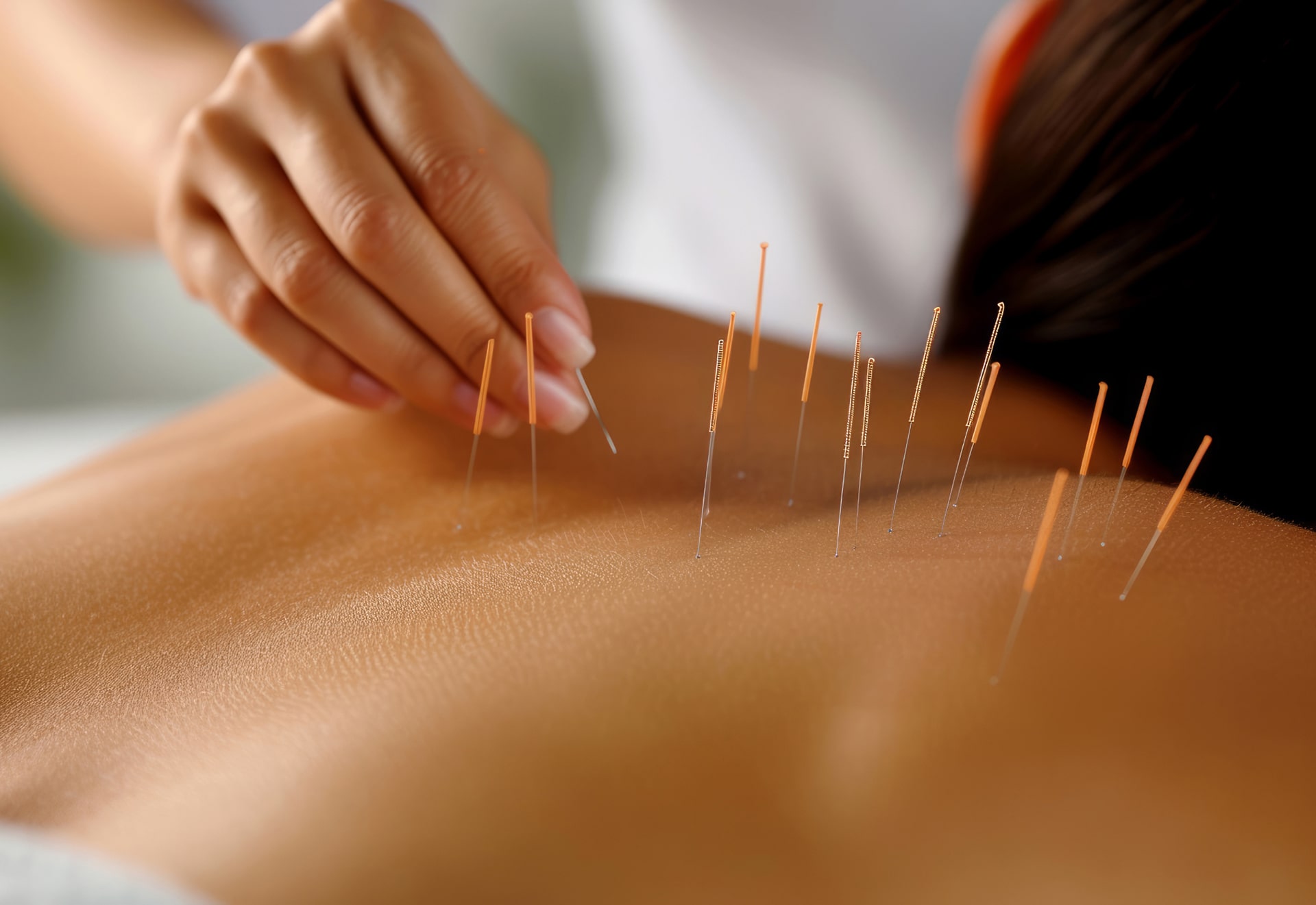 Acupuncture